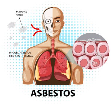 Akciğerlerdeki asbestozu gösteren diyagram