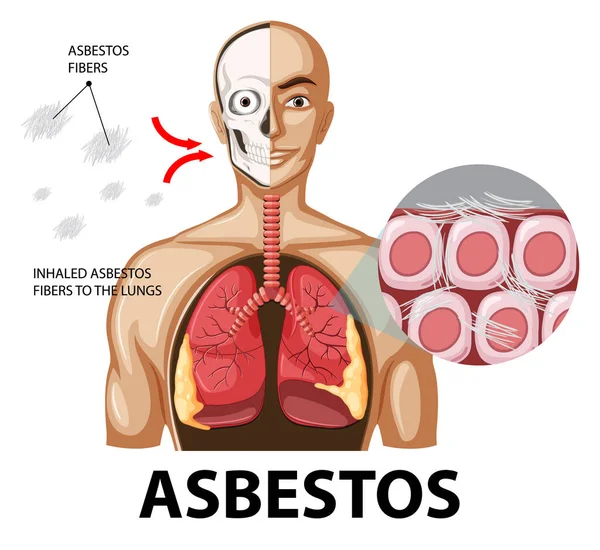 Schemat Przedstawiający Azbest Płucach Ilustracja — Wektor stockowy