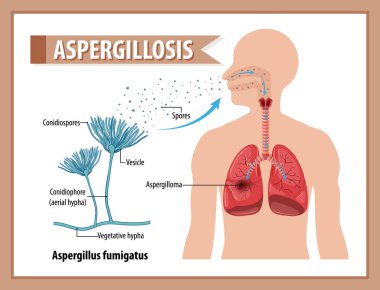 Diagram showing aspergillus infection illustration clipart