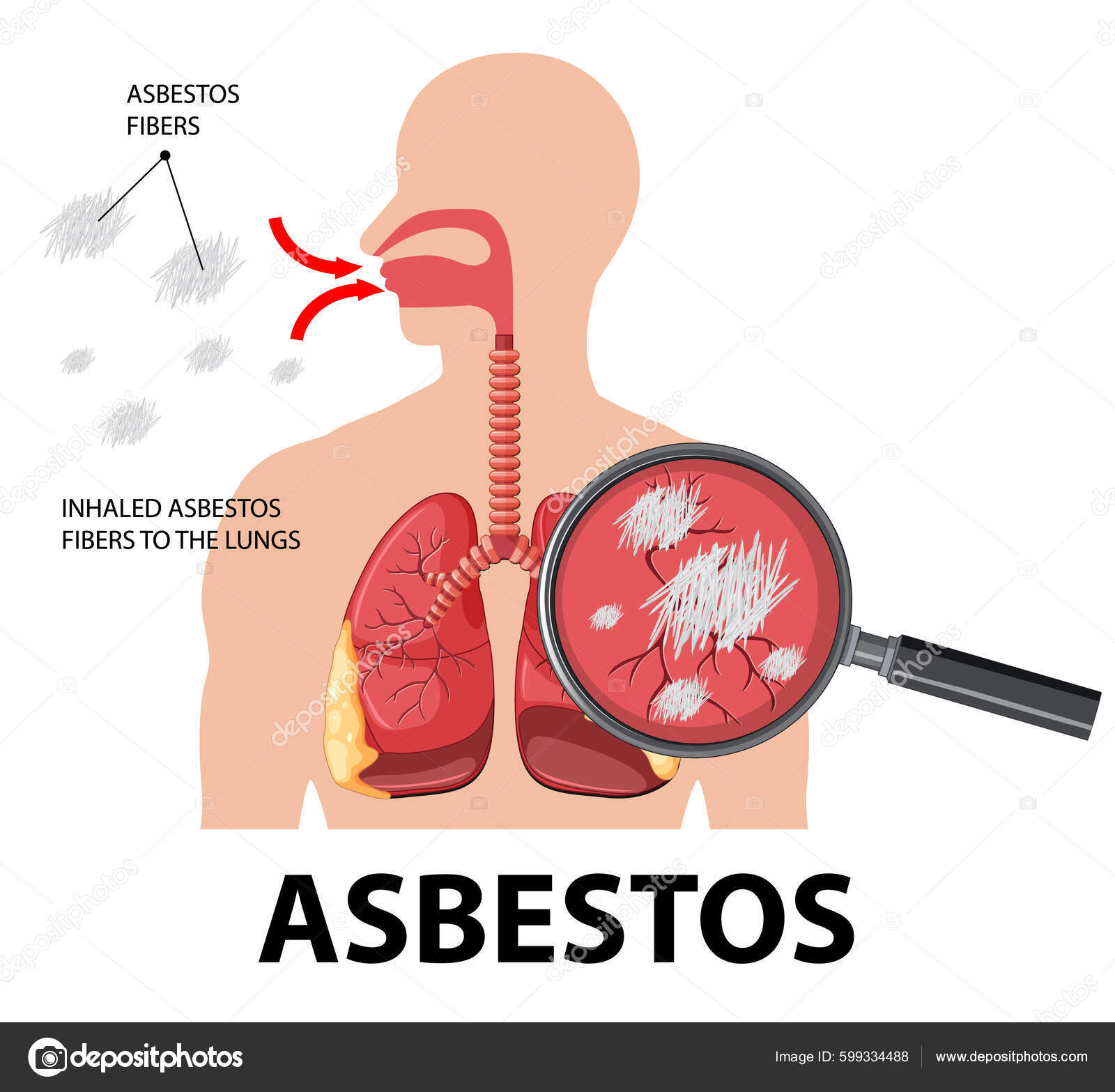 Diagram Showing Asbestosis Lungs Illustration Stock Vector Image by ©interactimages 599334488