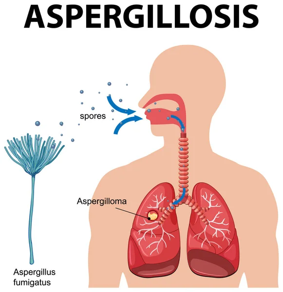 Diagrama Que Muestra Ilustración Infección Por Aspergillus — Vector de stock
