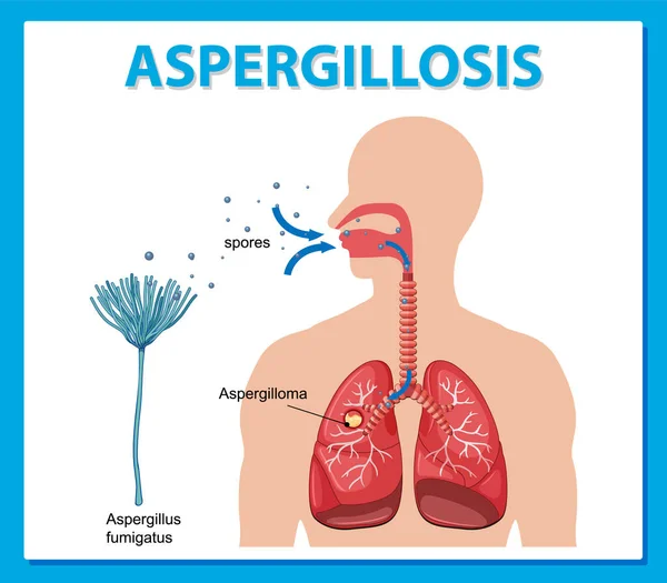 Grafik Zur Illustration Der Aspergillus Infektion — Stockvektor