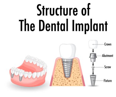 Diş implantı illüstrasyonunda insan yapısı hakkında bilgi
