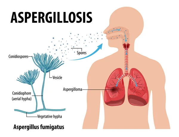 Diagrama Que Muestra Ilustración Infección Por Aspergillus — Archivo Imágenes Vectoriales