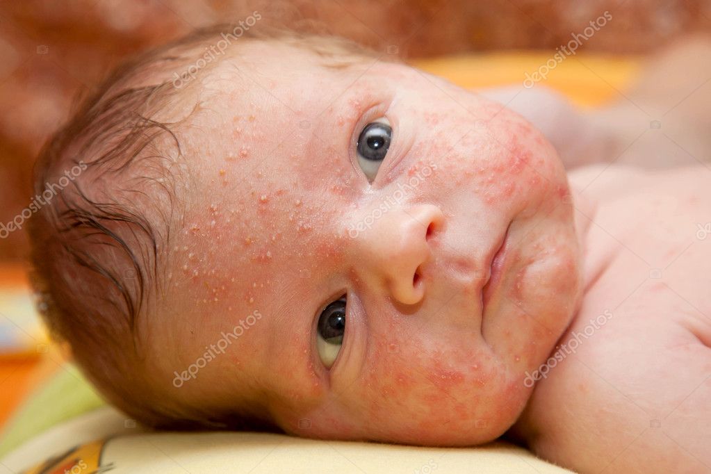 uitslag baby gezicht