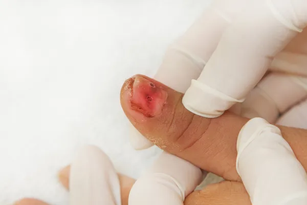 Podstawy urazów paznokci — Zdjęcie stockowe