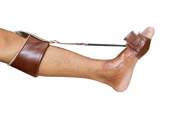 Trauma de joelho e tornozelo aplicar funda pé — Fotografia de Stock