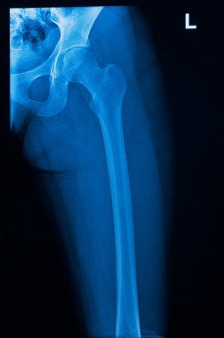 insan hip x-ray