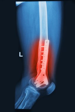 implant ile kırık insan uyluk x-ışınları görüntü ( plaka ve vida )