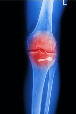x ray image painful of knee joint clipart