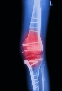X Rays image broken knee joint with implant,Image x-rays painfu clipart