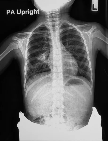 Crianças radiografia de tórax — Fotografia de Stock