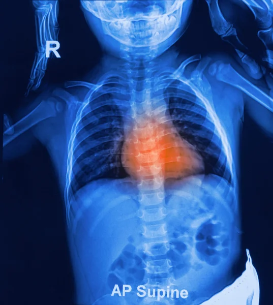 Radiografía de tórax infantil — Foto de Stock