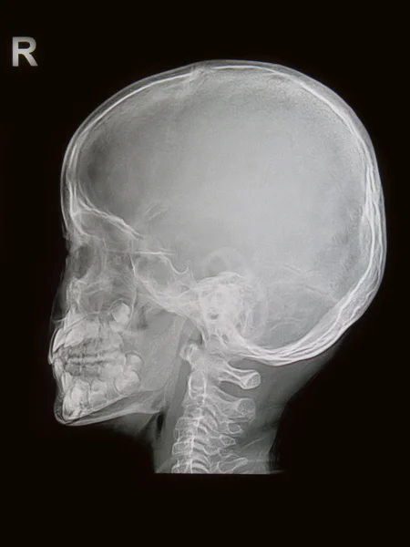 Children skull x-rays image — Stock Photo, Image