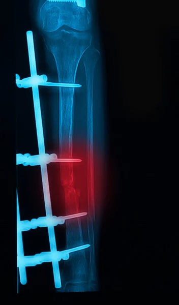 Рентгеновское изображение ноги, показывающее пластину и внешнюю фиксацию винта голени — стоковое фото