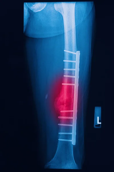 Imagen de rayos X del muslo humano roto con implante (placa y tornillo  ) — Foto de Stock