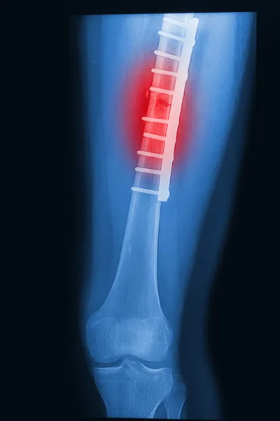 Trasiga mänskliga lår röntgenbild med implantat (plåt och skruv ) — Stockfoto