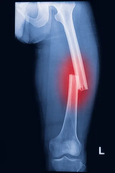 Röntgenbild gebrochener menschlicher Oberschenkel — Stockfoto