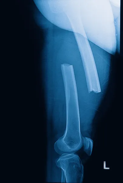 Broken human thigh x-rays image ,lelf leg fracture — Stock Photo, Image