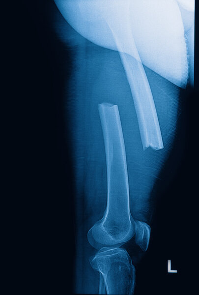 broken human thigh x-rays image ,lelf leg fracture
