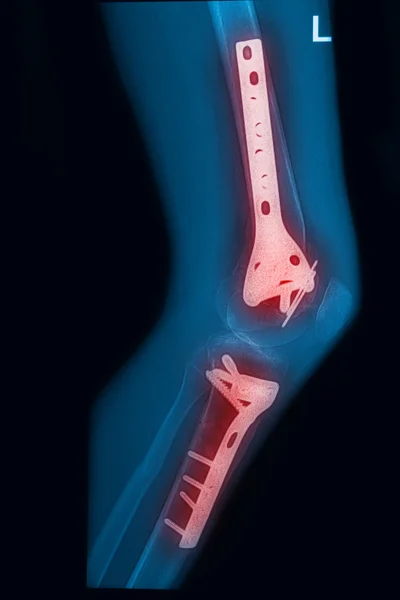 X-sugarak kép törött comb és a lábszár, implantátum, kép röntgensugarak posta — Stock Fotó