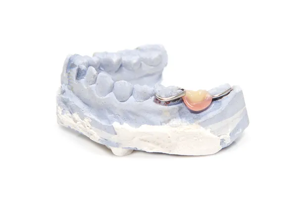 Dental prosthesis on gypsum model plaster — Stock Photo, Image