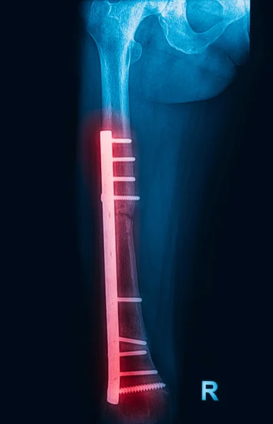 Fracture femur, femur x-rays image showing plate and screw fixat — Stock Image Fracture femur, femur x-rays image showing plate and screw fixat Royalty Free Stock Images