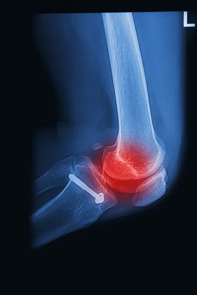 X Rays image broken knee joint with implant,Image x-rays painfu — Stock Image X Rays image broken knee joint with implant,Image x-rays painfu Royalty Free Stock Photos