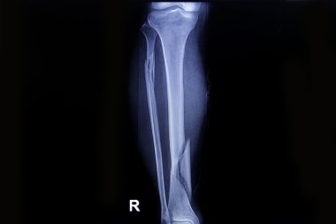 x-ray görüntü gösterme kırığı her iki bacak kemik