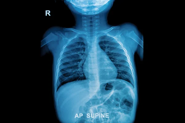 Chest x-ray of children — Stock Photo, Image