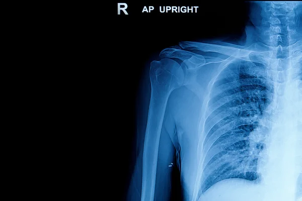 X-rays image of the  shoulder joint — Stock Photo, Image