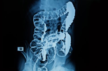 barium enema of a man demonstrated the normal rectum and cecum clipart