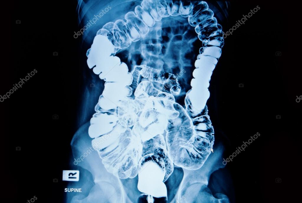 Barium enema of a man demonstrated the normal rectum and cecum — Stock