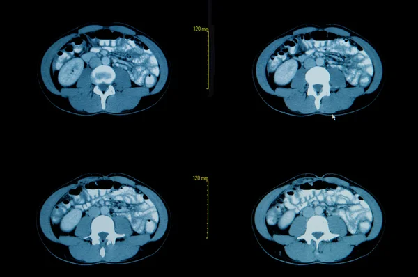 Datortomografi av bröstkorgen. medicinsk bakgrund — Stockfoto