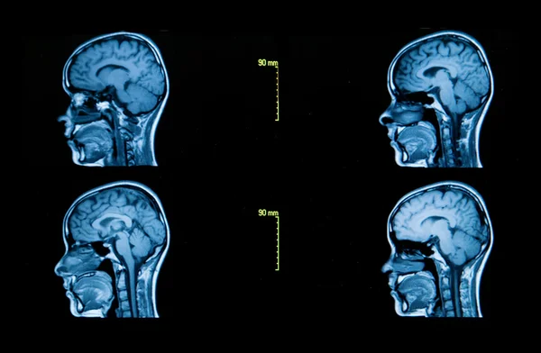 Serie de imágenes de una tomografía computarizada del cerebro — Foto de Stock