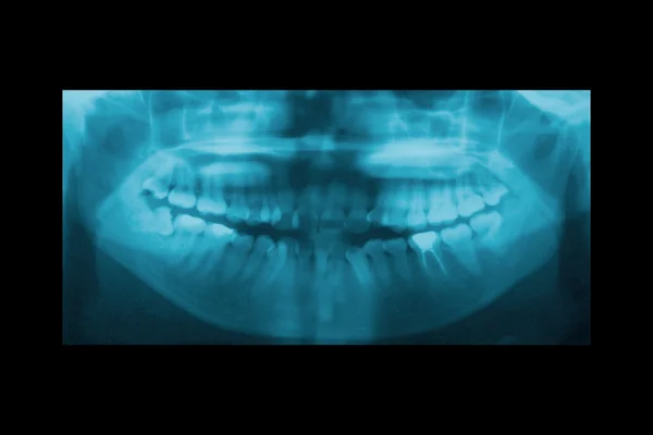 Panoramautsikt över dental röntgen för Ortodonti och käken ortopedi — Stockfoto