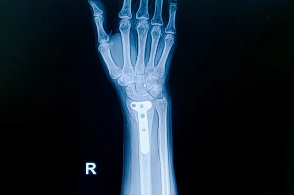 Film x-ray wrist fracture : show fracture distal radius (forear — Stock Photo, Image
