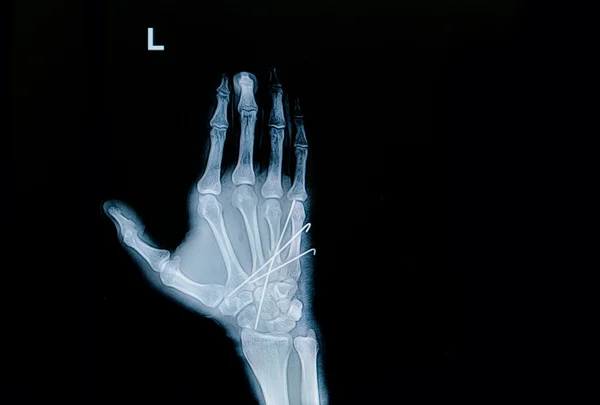 Radiografia por película da fractura da mão: mostrar fractura metacarpal osso inse — Fotografia de Stock