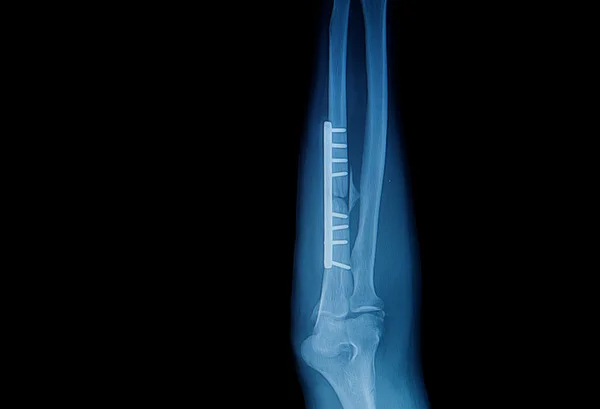 Fracture forearm with  internal fixed by plate and screw — Stock Photo, Image