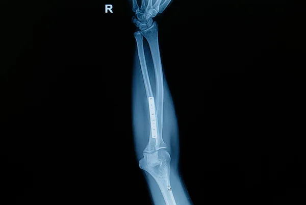 Film x-ray forearm fracture : show fracture ulnar bone with inse — Stock Photo, Image