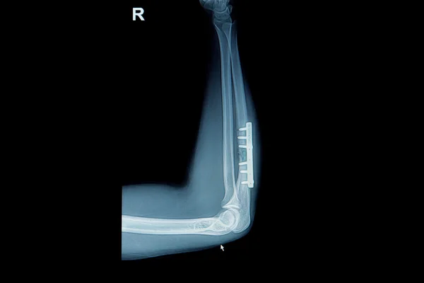 Рентгеновский перелом запястья: видимый перелом лучевой кости предплечья — стоковое фото