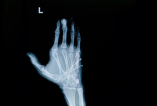 Film x-ray of hand fracture : show fracture metacarpal bone inse — Stock Photo, Image