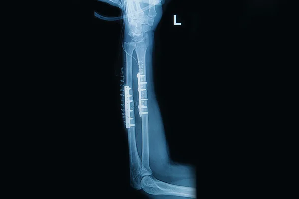 Film x-ray pols fractuur: breuk radius en ulna (onderarm — Zdjęcie stockowe