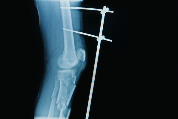 x-ray image of fracture leg ( tibia )with implant external fixat