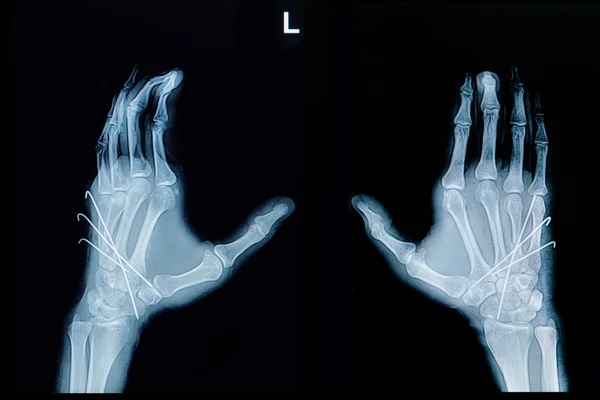 Film X-ray de fracture de la main : montrer fracture métacarpienne os rincer — Photo