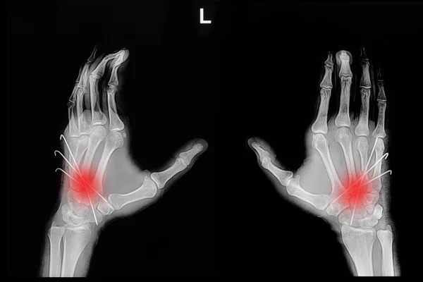 Radiografia por película da fractura da mão: mostrar fractura metacarpal osso inse — Fotografia de Stock