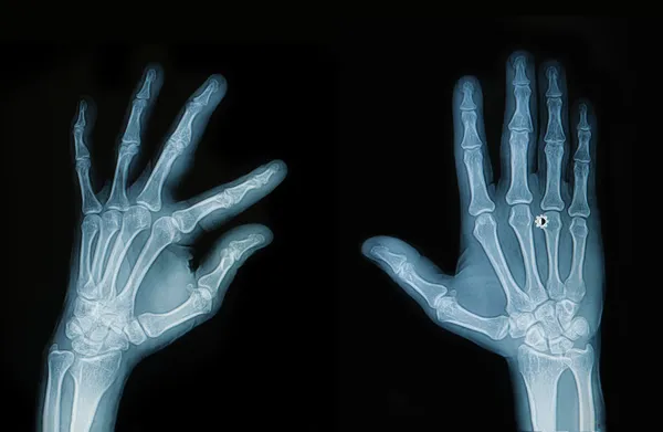 Рентген рук и пальцев — стоковое фото