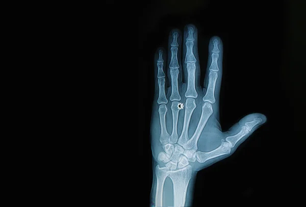 X-ray hand en vinger — Stockfoto