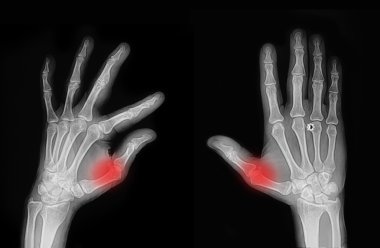 X-ray hand and finger clipart