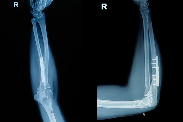 Fracture du poignet à rayons X : montrer un rayon de fracture osseuse (avant-bras — Photo
